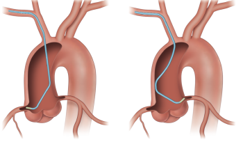 Illustration of Tiger (Universal Engagement) OPTITORQUE placement